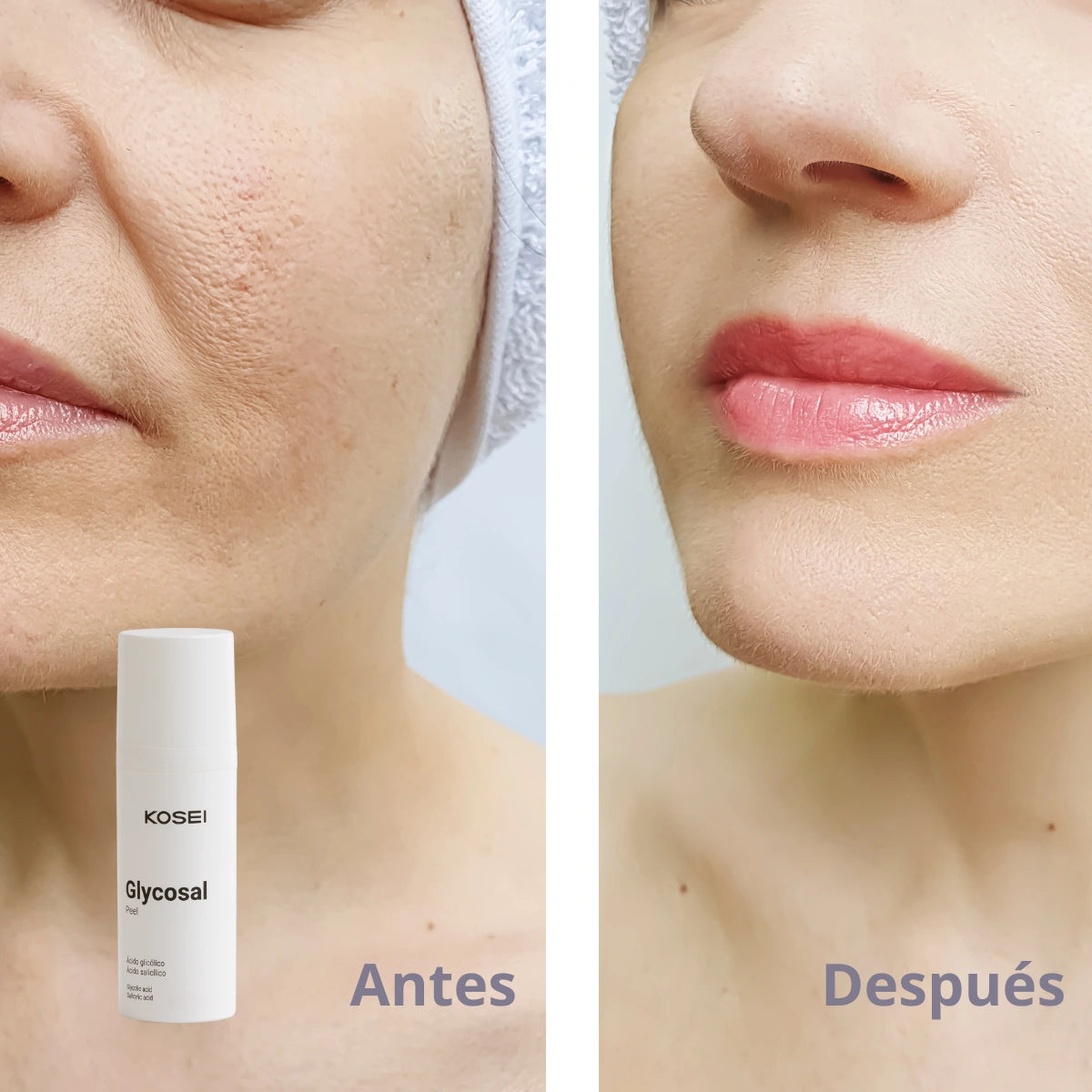 acido glicolico peeling productos kosei glycosal