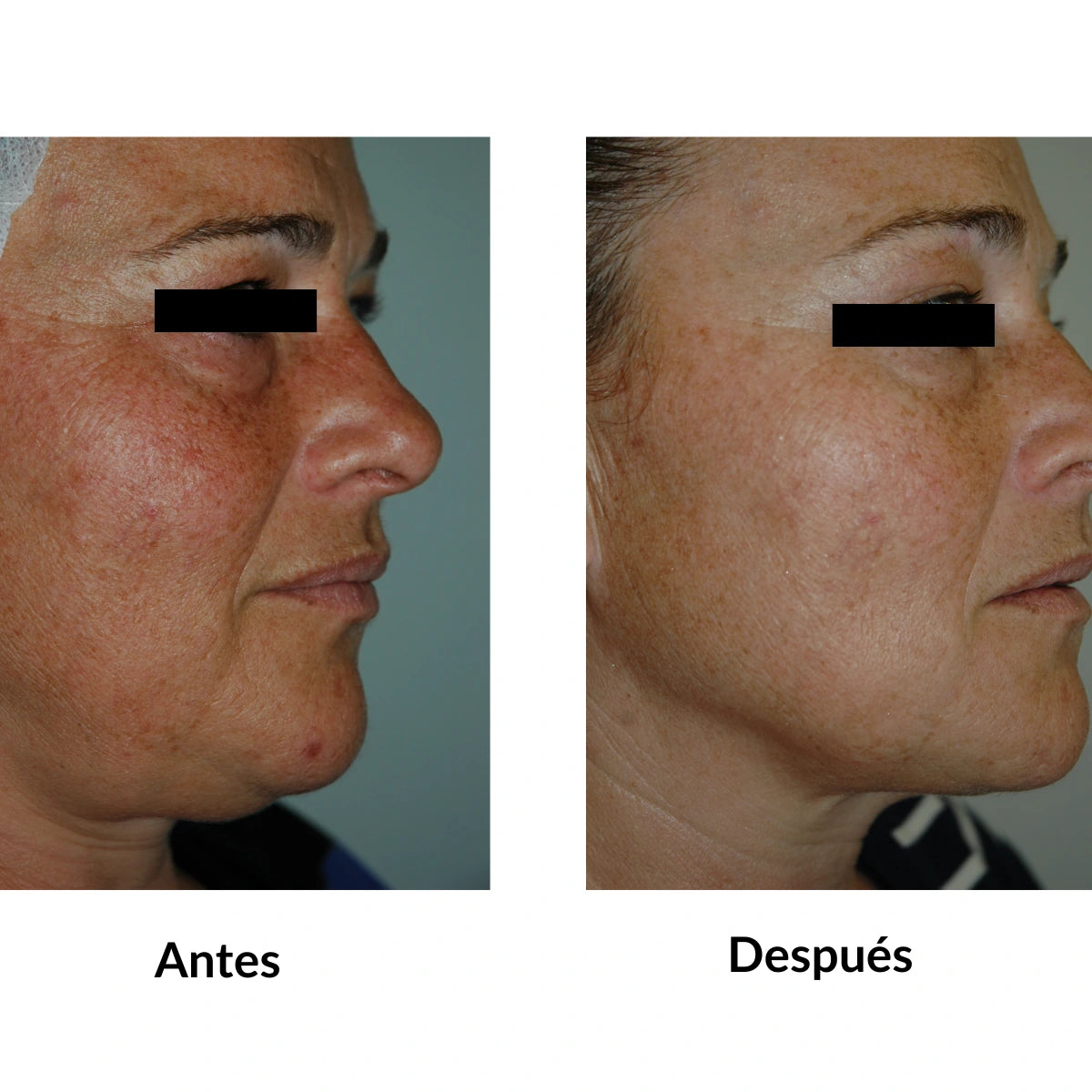 crema despigmentante kosei mela xpert