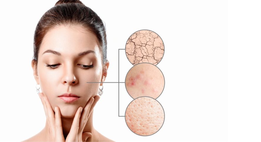 Los 4 mejores productos anti acné