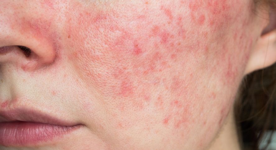 Rutina Facial para Piel Rosácea