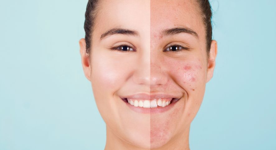 Rutina facial anti acné