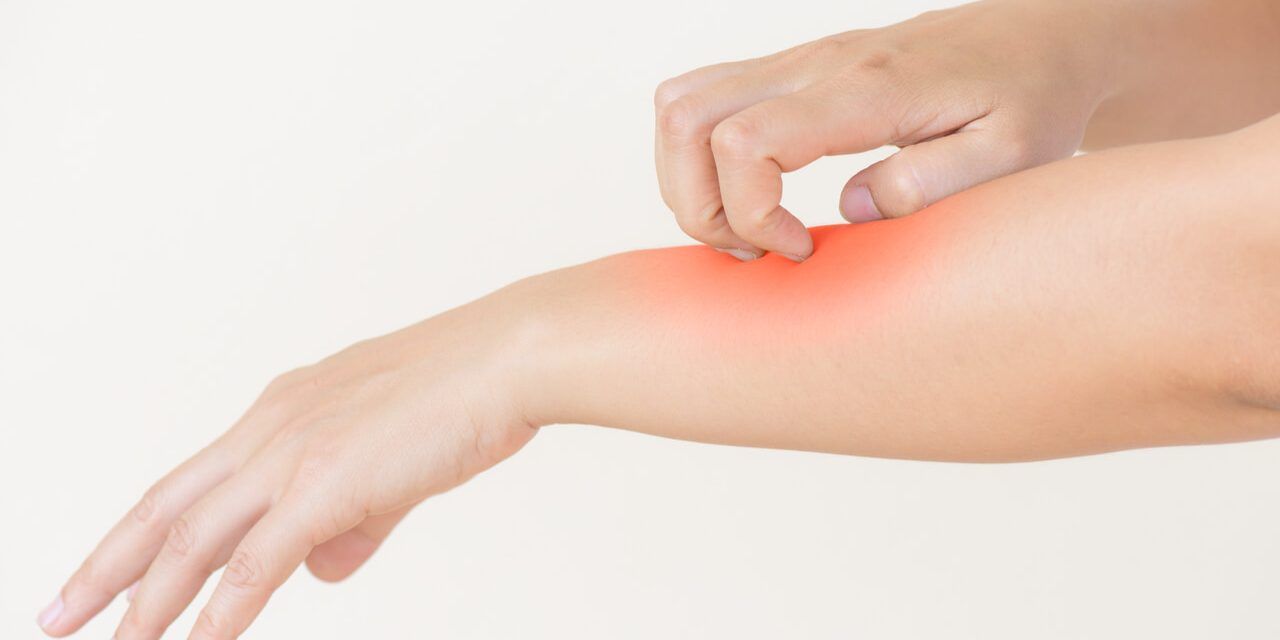 ¿Qué es un eczema? Tipos y cómo tratarlos